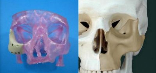 Approvato il primo innesto osseo maxillo facciale stampato 3D