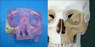 Approvato il primo innesto osseo maxillo facciale stampato 3D